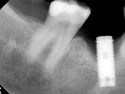 Peri-implantitis case (bone graft)