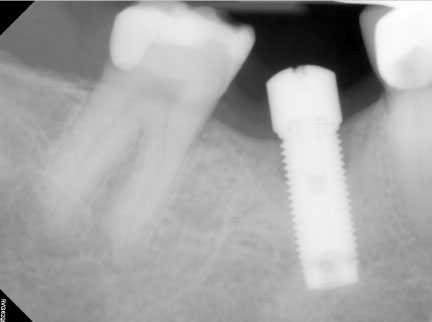 Peri-implantitis case (bone graft)