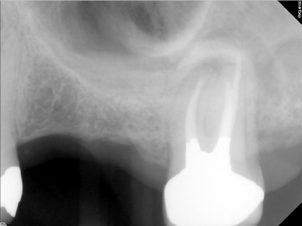 before (4mm vertical bone height)