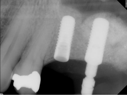 over 6mm bone height gained before placing implant in the same day)