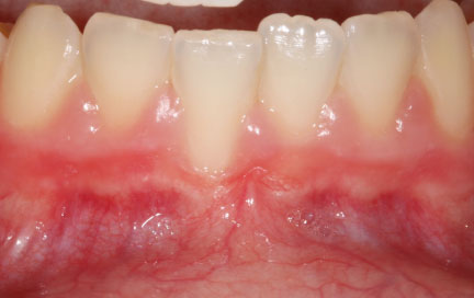 before frenectomy with free gingival graft