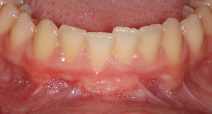 after frenectomy with free gingival graft