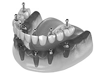 implant-supported dentures