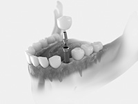 single tooth dental implants