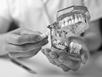 implant-supported bridges