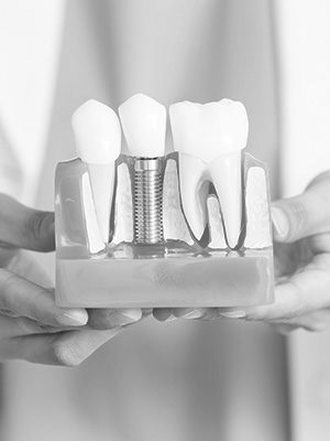 Dental Implants